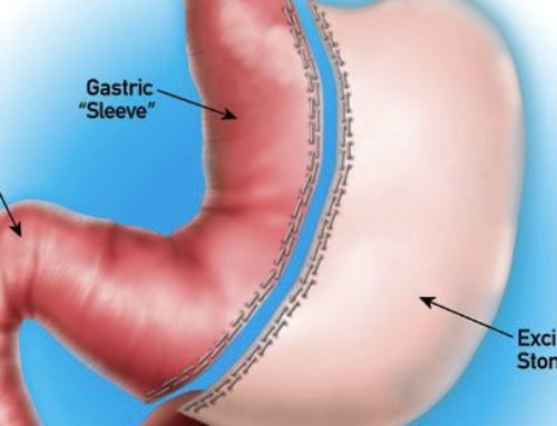 Gastric Sleeve – Bariatric Institute of Chicago