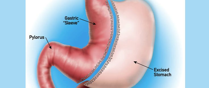 Gastric Sleeve – Bariatric Institute of Chicago
